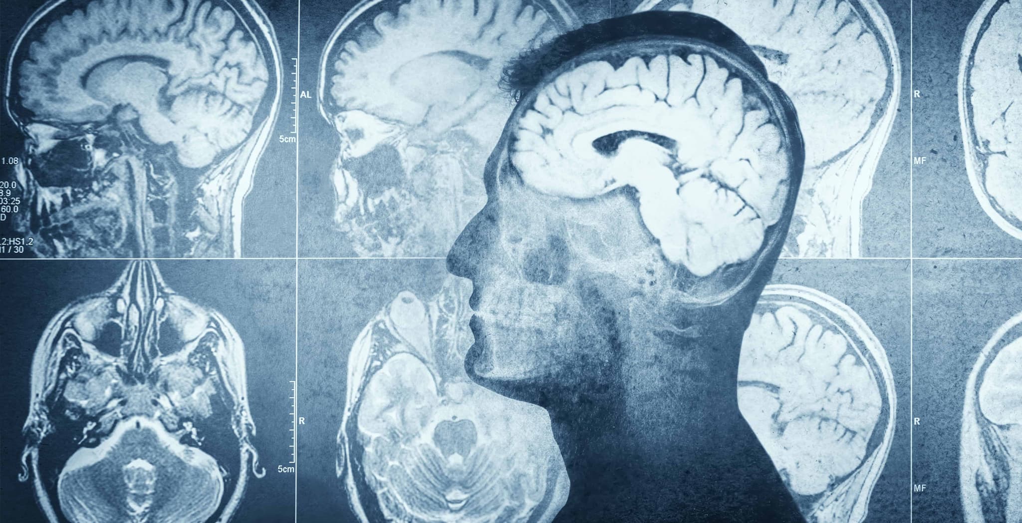 Getting a dementia diagnosis